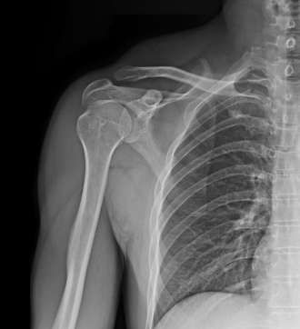 X-ray of chest/shoulder