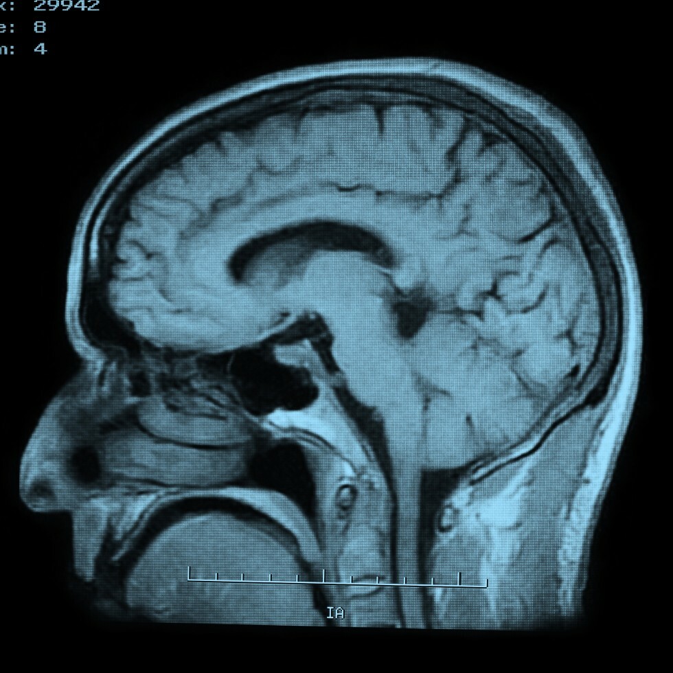 MRI of Brain