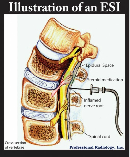 Illustration of an ESI