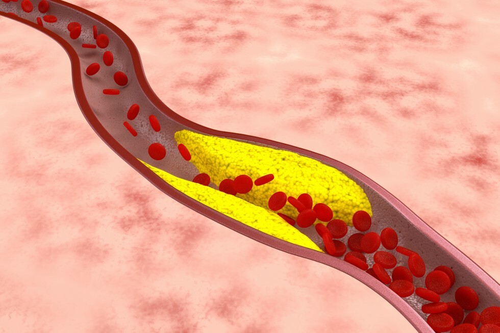 Atherosclerotic plaque art