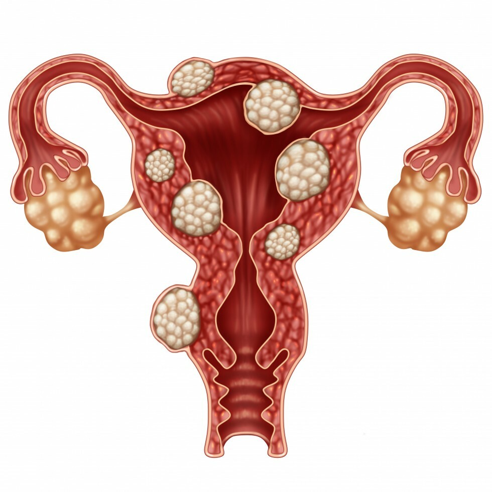 Uterine Fibroids model