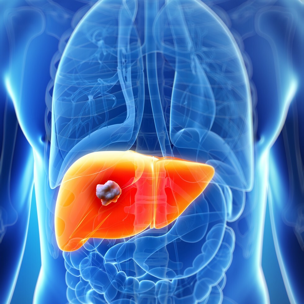 model of liver cancer