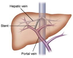 Hepatic vein, stent, and portal vein model